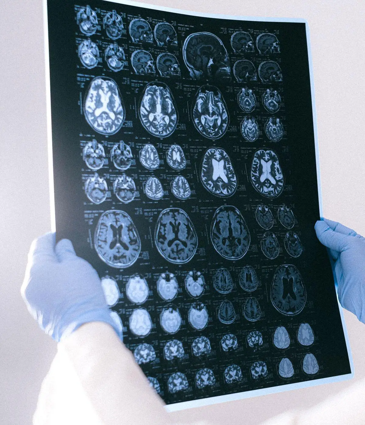 Imagen resonancia de esclerosis múltiple