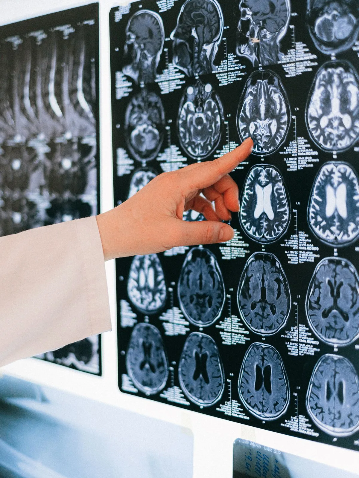 Neurólogo señalando una resonancia magnética cerebral en la evaluación del deterioro cognitivo